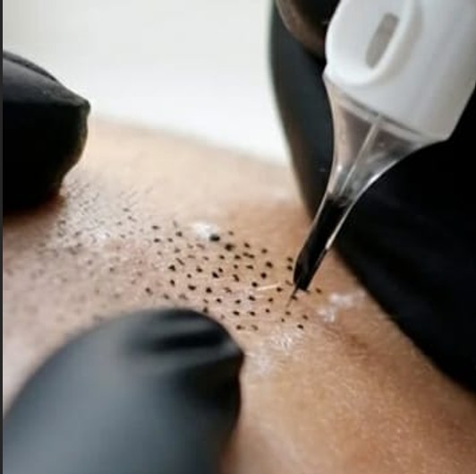 Micropigmentación paramédica